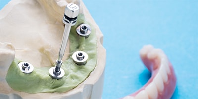 Servizi: Implantologia e Chirurgia orale - Viaggi Dentali Croazia